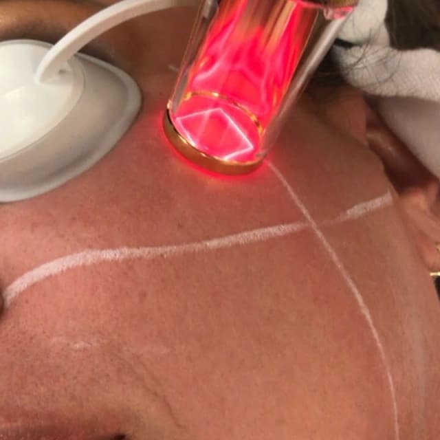 RINOVARE FRAXEL LASER at Remake Beauty Studio Mission in Mission, TX